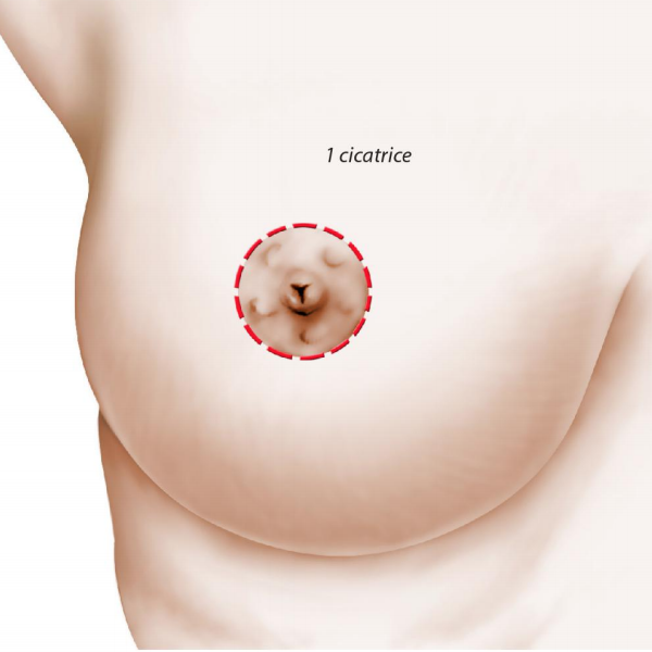 Schéma opératoire Lifting mammaire