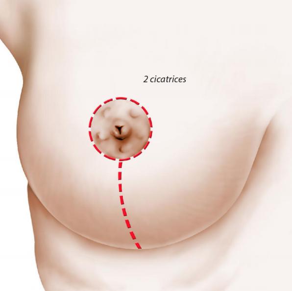 Schéma opératoire Lifting mammaire