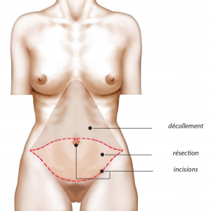 Chirurgie d'abdominoplastie