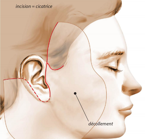 Schéma lifting cervico-facial