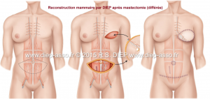 Chirurgie Reconstructrice DIEP