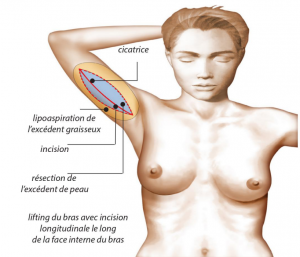 Schéma chirurgie lifting de bras