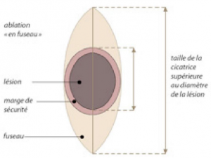 Schéma chirurgie cutanée 2