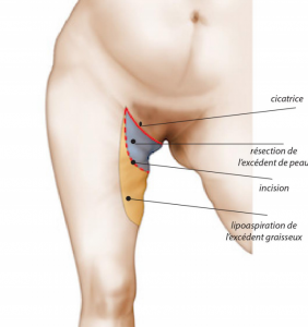 Schéma lifting de cuisse