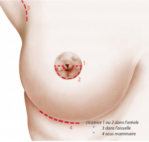 coupe coronale chirurgie mammaire Ajaccio Corse