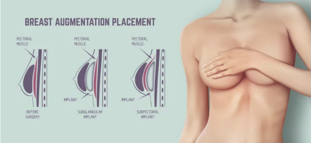 Placement prothèses mammaires